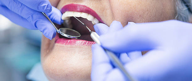 Best Knocked-Out Tooth (Avulsed Tooth) Treatment in Pine Lakes, FL